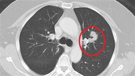 肺癌復發恐切肺？「冷凍微針」來解圍（國泰醫院提供）