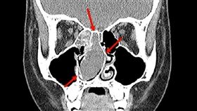 塵蟎過敏導致鼻息肉肥大喪失嗅覺。(圖／翻攝畫面)