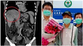 67歲翁肝癌「肺轉移還侵犯心臟」　免疫療法讓他重生（安南醫院提供）