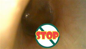 耳朵有蟲（北市聯醫提供）