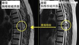 比較術前與術後之胸椎核磁共振，可確認腫瘤已被完全移除（圖／台大醫院新竹分院提供）