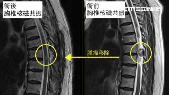 下肢麻木＝腰椎退化？小心脊椎腫瘤