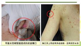 起疹以為過敏　皮膚「發泡」驚覺不妙（台中醫院）