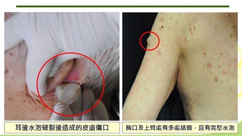 起疹以為過敏　皮膚「發泡」驚覺不妙