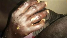 皮膚病,漁民,感染,發黃,掉屑,生殖器