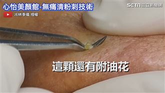 小珍珠粉刺小巧玲瓏　一擠飽滿彈出來