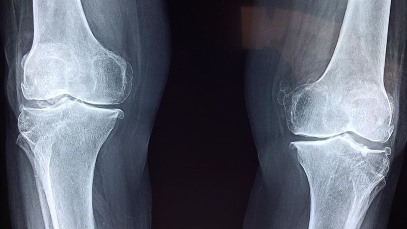 癌細胞「骨轉移」　他一起床腿骨斷掉