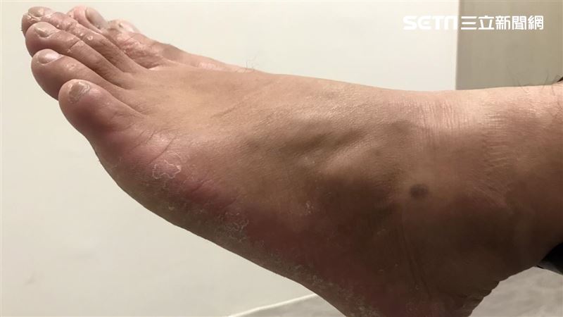 疏忽這些事　36歲卻有60歲的腳