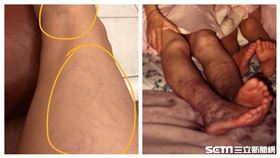 靜脈曲張(讀者提供)