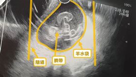 產婦「臍帶脫垂」（門諾醫院提供）