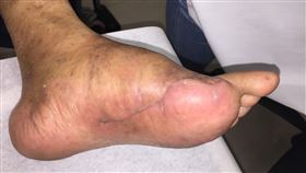 安南醫院,整形外科及傷口中心,唐慧君,糖尿病足,糖尿病
圖／安南醫院提供