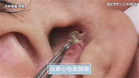 ▲夾出一顆超巨大的黑頭。（圖／JE林季儀 授權）