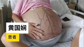 貴州,巨肚,腫瘤,媽媽,腹水,孕婦,肚子
