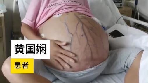 婦肚2年狂脹如巨球　肚皮爆青筋險破