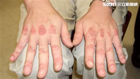身體出現不尋常紅疹、四肢無力？當心皮肌炎上身（圖／亞東醫院提供）