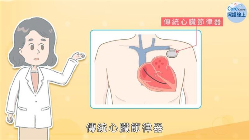 心跳漏拍、跳太慢　談「心臟節律器」