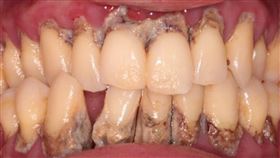 不抽菸喝酒吃檳榔　但忽略這事、38歲男滿口牙結石（圖／台中慈濟醫院提供）