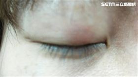 童綜合醫院眼科主任陳沛仁提醒，預防長針眼，除了保持正常作息外，也要清淡飲食。（圖／童綜合醫院提供）