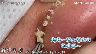 鼻翼暗藏粉刺林　驚人奶油花噗滋冒出