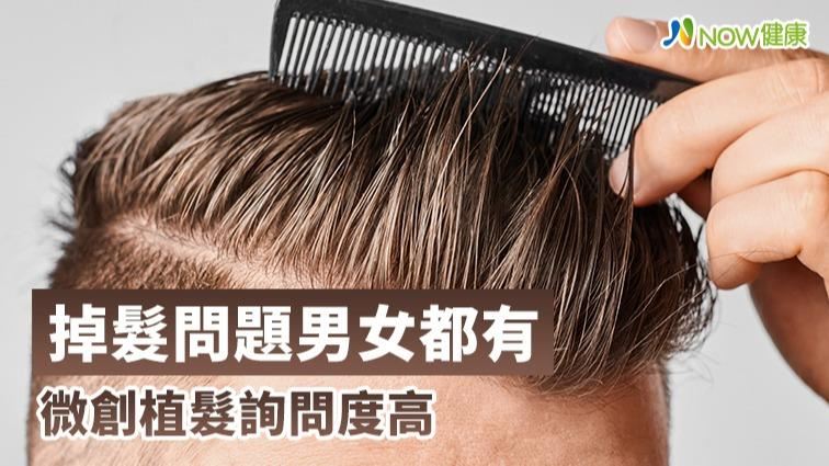 掉髮沒有男女之分　微創植髮增髮量