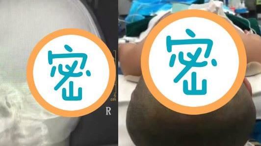 女童睡覺摔下床　後腦勺釘入這1條