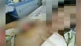 胸部,縮胸,皮膚壞死,手術失敗,醫院,醫療糾紛