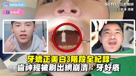 牙矯正美白3階段全紀錄　齒神經被刷出網崩潰：牙好癢