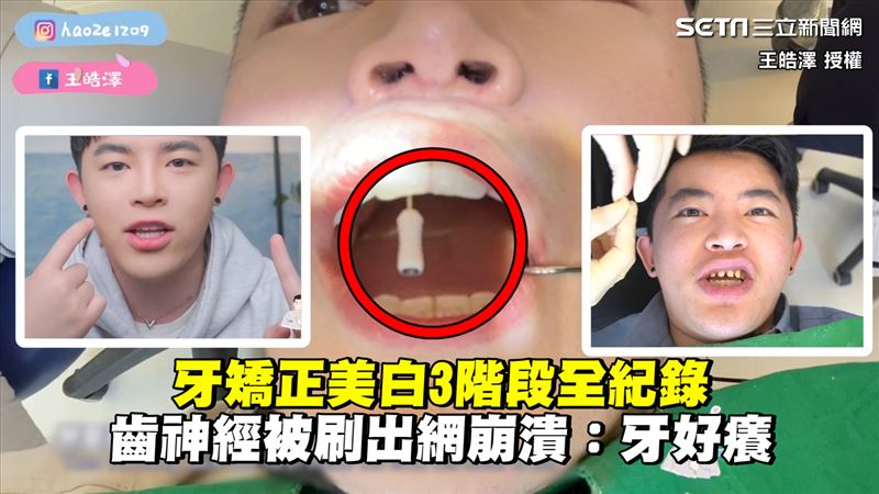 牙矯正美白全紀錄　刷出齒神經網崩潰