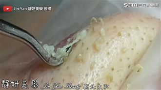 粉刺油脂分泌旺盛　一擠如湧泉四處噴