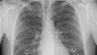 可怕！肺癌60％一發現就是晚期