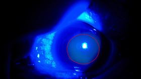 貪俗！22歲女網購廉價隱形眼鏡　戴到角膜破皮、狂吐不止（圖／亞大醫院提供）