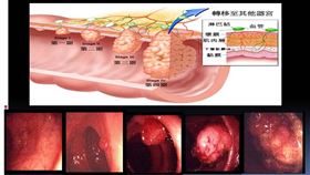 大腸癌,安南醫院,息肉,黃文威
圖／安南醫院提供