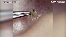 超巨陳年粉刺大如白蟲　專業高手清除罪魁禍首超爽快