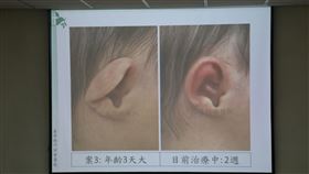 爸媽別擔心！新生兒耳朵變形「耳朵矯正器」可改善（門諾醫院提供）
