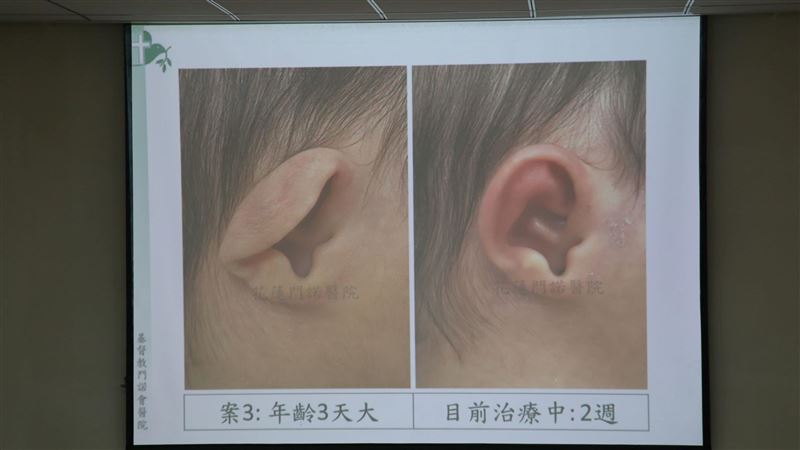 新生兒耳朵變形　免手術靠這一招矯正