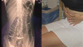 23歲女貼驚人X光片：大腸長到心臟了（圖／媛西授權提供）