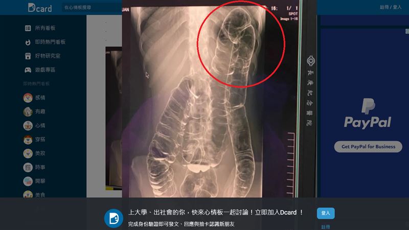 大腸都是ㄇ字形？醫：有人九彎十八拐
