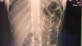 23歲女貼驚人X光片：大腸長到心臟了（圖／媛西授權提供）