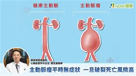 名家專用／NOW健康／腹主動脈瘤又有「沉默炸彈」之稱，在破裂以前，患者鮮少感到不適或疼痛。(勿用)
