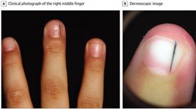 黃瑽寧醫師分享個案，8歲男童接觸含聚氯乙烯、聚丙烯的史萊姆後，指甲竟長出黑線。(圖／黃瑽寧醫師健康講堂粉絲團提供)