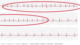 頭暈8年無解！48歲男戴蘋果手錶2周診斷出「心律不整」