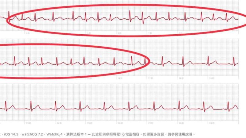 頭暈8年戴蘋果手錶2周抓到心律不整
