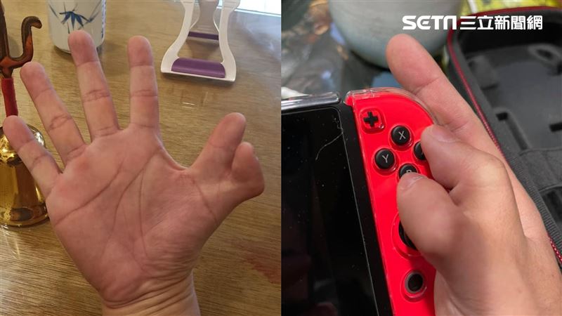 罕見6指男挨轟怪物　現況曝光網讚爆