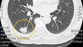 肺癌,彰化醫院,衛福部,痔瘡,衛福部彰化醫院胸腔內科醫師林澤宏