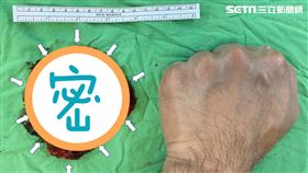 達文西手臂揪出9.5cm巨型腫瘤(陳百璽醫師授權，其他新聞勿用)