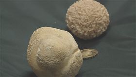 泌尿道感染／膀胱結石／頻尿／高醫／1050顆結石。（圖／高醫大附設醫院提供）