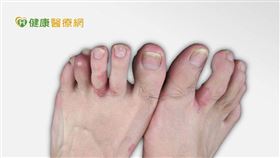 「目前乾癬性關節炎的治療上，希望儘早從乾癬性關節炎患者中，診斷出容易演變成快速關節破壞的族群，給予適當的治療，而非僅使用非類固醇消炎止痛藥。」