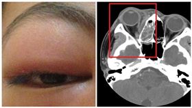 嚴重會喪命　長期鼻塞竟釀蜂窩組織炎（台北慈濟醫院提供）