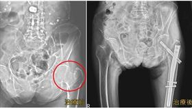 9旬嬤一跌就骨折　醫驚：骨密超低「像易脆的蛋捲」（圖／亞大醫院提供）