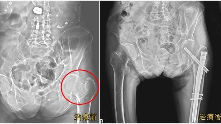 9旬嬤一跌就骨折　醫驚：像易脆蛋捲